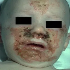 Objawy niedoboru cynku u dzieci zespół Danbolta-Clossa