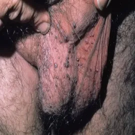 Okolice intymne choroby zdjęcia rogowiec krwawy