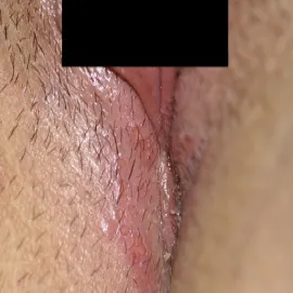 Opryszczka warg sromowych