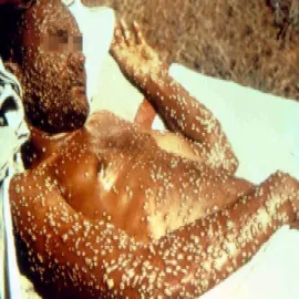 Ospą prawdziwa zdjęcia