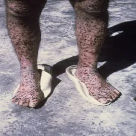 Ospa prawdziwa zdjęcie