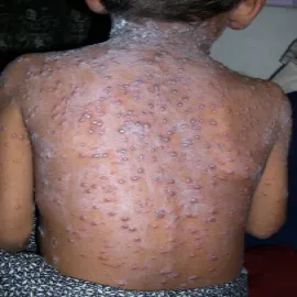 Ospa wietrzna objawy