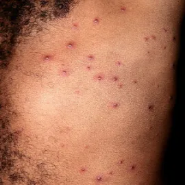 Ospa wietrzna u dorosłego mężczyzny