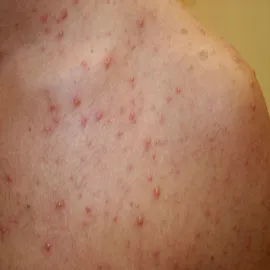 Ospa wietrzna wysypka na skórze