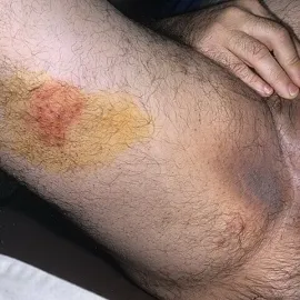 Półpasiec na udzie