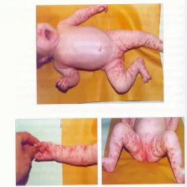 Pęcherzyca syfilityczna