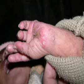 Pęcherzyki na dłoniach rękach u dziecka świerzb