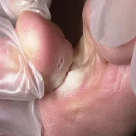 Pękająca skóra między palcami u nóg stopa atlety