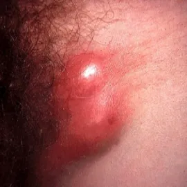 Pachwina choroba weneryczna