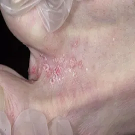 Pierwsze objawy grzybicy na stopach stopa sportowca