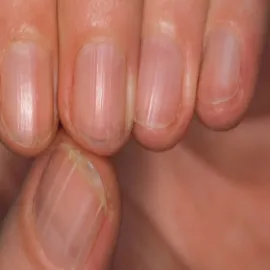 Pionowa biała kreska na paznokciu