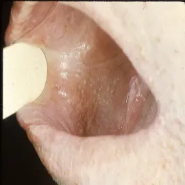 Plamki fordyce na poliku