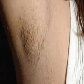 Plamki fordyce'a pod pachą