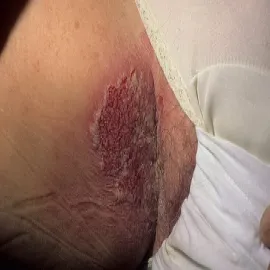 Podrażnienia, rany w okolicach intymnych choroba Haileya-Haileya
