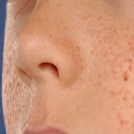 Podskórne grudki na twarzy gruczolak łojowy