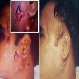 Promienica zdjęcia choroby