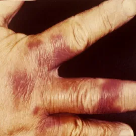 Różyca u ludzi zdjęcia