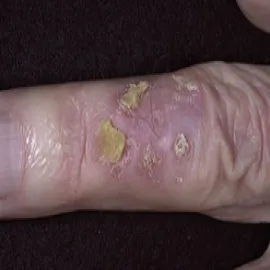 Rogowacenie słoneczne na palcu