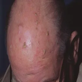 Rogowacenie słoneczne na skórze głowy