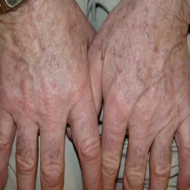 Rogowacenie starcze na dłoniach