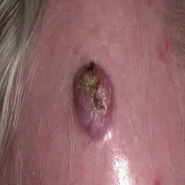 Rogowiak kolczystokomórkowy (keratoacanthoma)