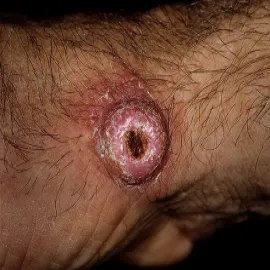 Rogowiak kolczystokomórkowy choroba skórna