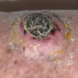 Rogowiak kolczystokomórkowy guz skórny 