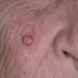 Rogowiak kolczystokomórkowy guzek na poliku