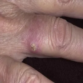 Rogowiak kolczystokomórkowy na palcu