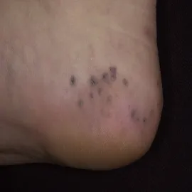 Rogowiec krwawy na pięcie