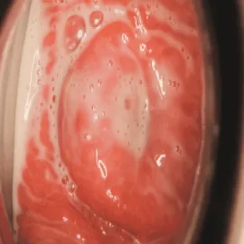 Rzęsistkowica u kobiet