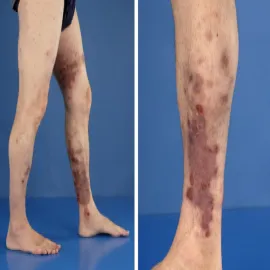 Rzadka choroba autoimmunologiczna eozynofilowe zapalenie tkanki podskórnej