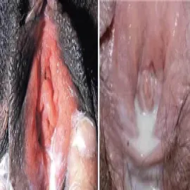 Rzeżączka objawy u kobiet