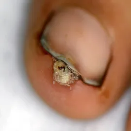 Sarkopsyloza zdjęcie