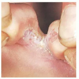 Schodząca skóra między palcami u nóg stopa sportowca 