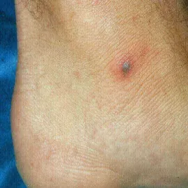 Stopa guzek rzeżączka choroba