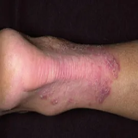 Stopa sportowca, grzybica nóg