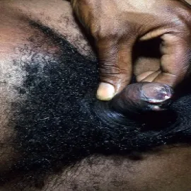 Szankroid choroba przenoszona drogą płciową