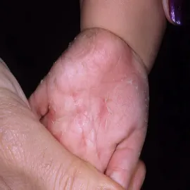 Szkarlatyna na dłoniach u dzieci