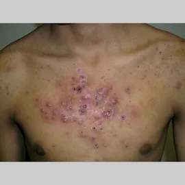 Trądzik piorunujący na klatce piersiowej