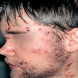 Trądzik piorunujący na twarzy