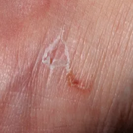 Tunele w skórze świerzb