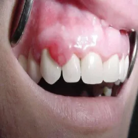 Twarde zgrubienie nad zębem nadziąślak 