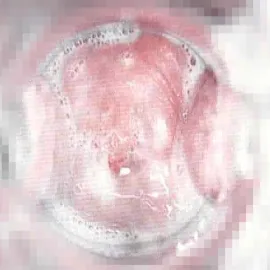 Upławy pieniste i o przykrym zapachu 