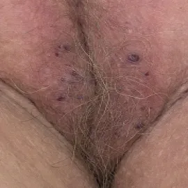 Wargi sromowe choroby zdjęcia rogowiec krwawy