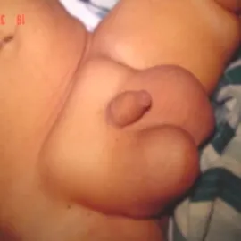 Wodniak jądra u chłopca