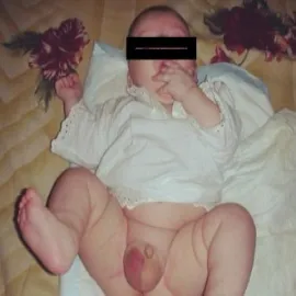 Wodniak jądra u noworodka