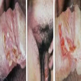 Wrzód-weneryczny zdjęcie