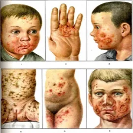 Wygląd liszajec na skórze