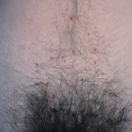 Wypryski na skórze w okolicach intymnych u kobiet